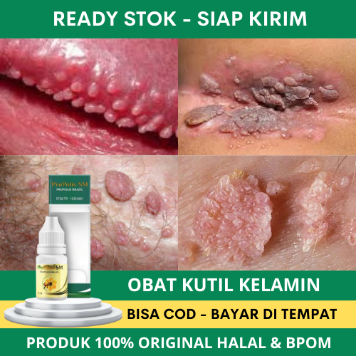 Obat Kutil Kelamin Pria, Obat Kutil Kelamin Wanita, Obat Perontok Kutil Kelamin Pria Dan Wanita, Oba