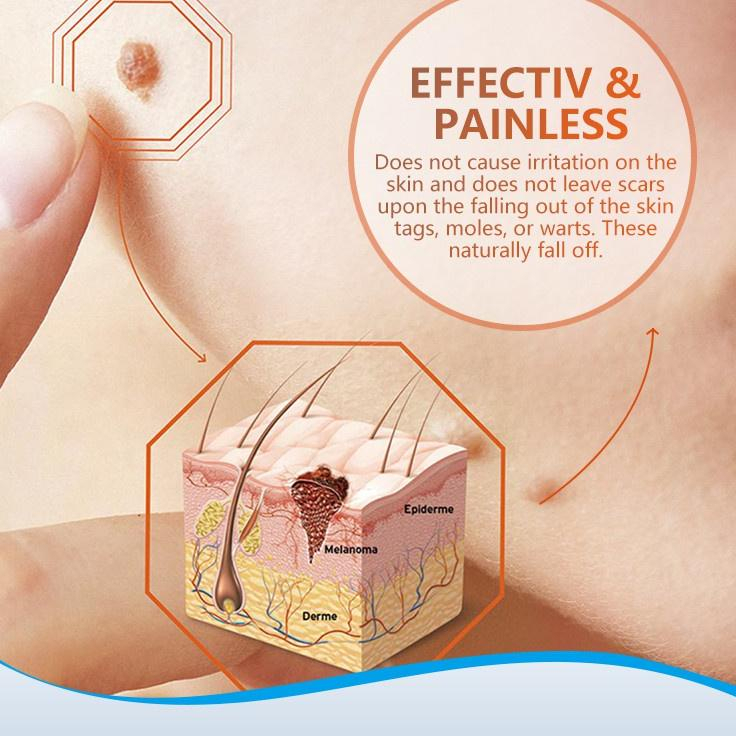 Krim Penghilang Tahi Lalat di Wajah Permanen - Sumifun Wart Remover Original