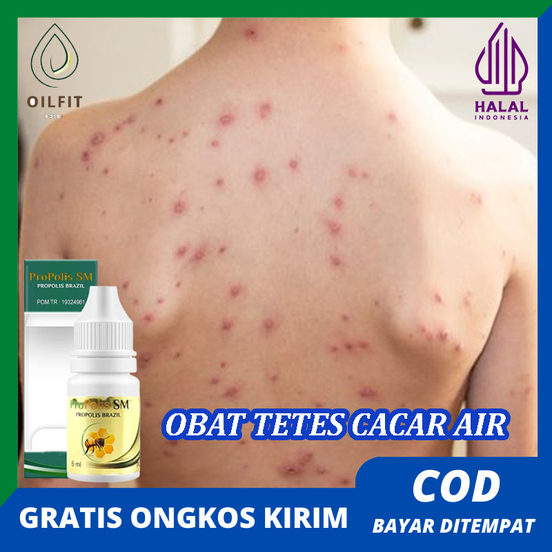 Obat Cacar Air Cacar Api Penghilang Bekas Cacar Herpes Campak Agar Cepat Sembuh
