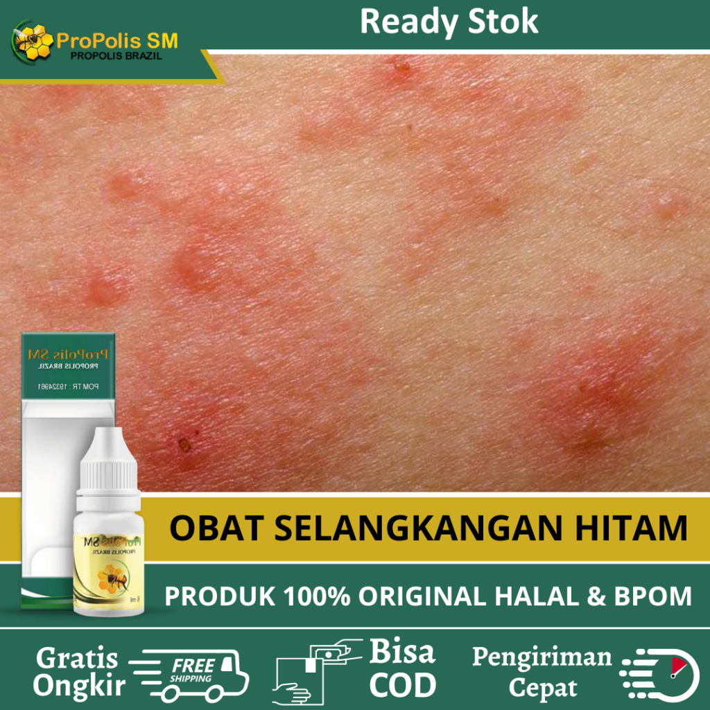 Obat Selangkangan Hitam Dan Gatal, Obat Gatal Selangkangan Pria Wanita, Obat Jamur Kulit Selangkanga