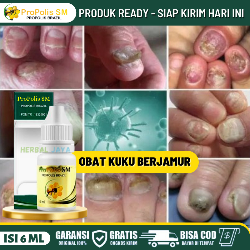 Obat Oles Kuku Berjamur, Obat Kuku Sakit, Obat Kuku Borok, Obat Psoriasis Kuku, Obat Kuku Kembali Ba