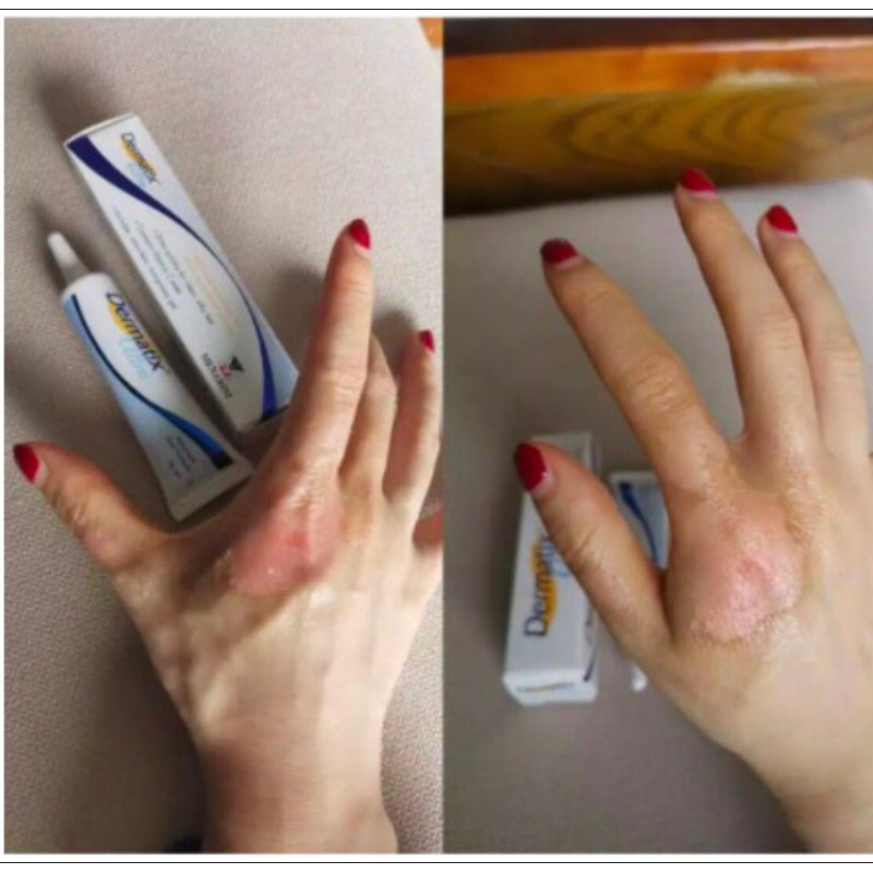 Dermatix Ultra Gel 15g Penghilang Bekas Luka / Keloid ANTI SCAR Stretc