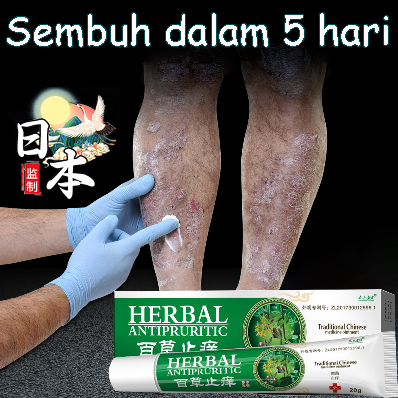 krim herbal untuk eksim Salep kulit psoriasis Psoriasis Ointment Original 30g Krim Pengobatan Eksim,