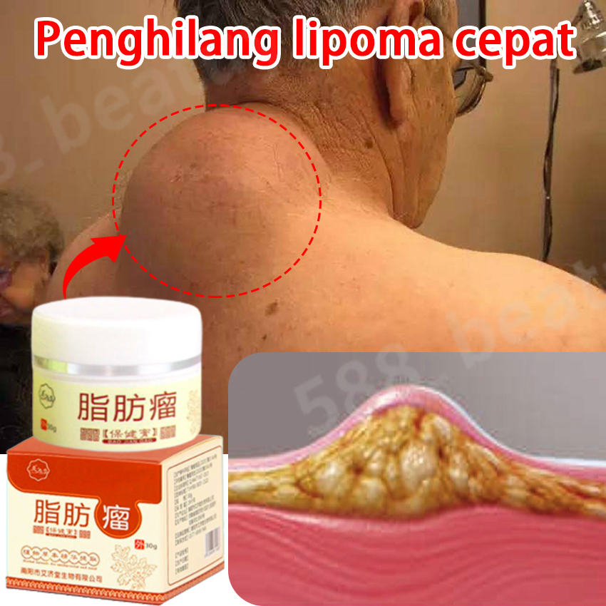 30gr Obat Benjolan/Obat Lipoma/Krim Lipoma/Lipoma Salep/Obat Benjolan Di Leher - Obat Oles Penghilang Benjolan Lipoma