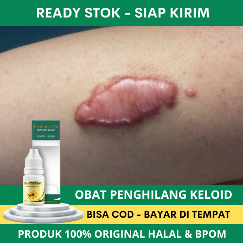 Obat Keloid, Obat Keloid Daging Tumbuh, Obat Penghilang Keloid, Obat Keloid Menahun, Penghilang Beka