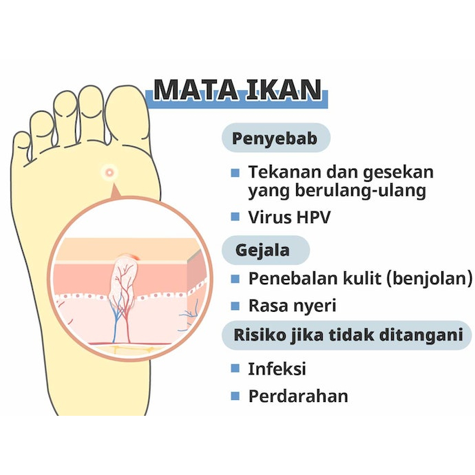 [ORI] Ji Yen Tie Plester Obat Kutil Mata Ikan Kapalan - 1 Box Isi 6 Pcs