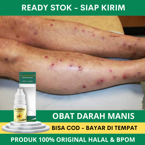Obat Darah Manis, Bentol, Prurigo, Penyakit Kulit, Kulit Gatal Gatel, Salep Korengan Kaki Dan Tangan