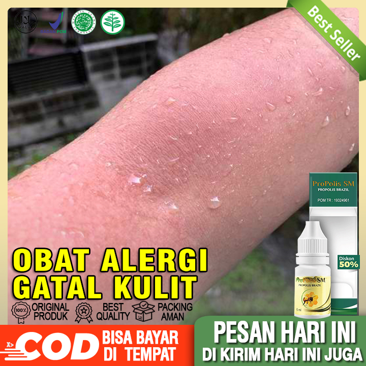 Obat Alergi Gatal Kulit Obat Gatal Seluruh Badan Obat Gatal Bokong Dan Selangkangan Obat Gatal Berai