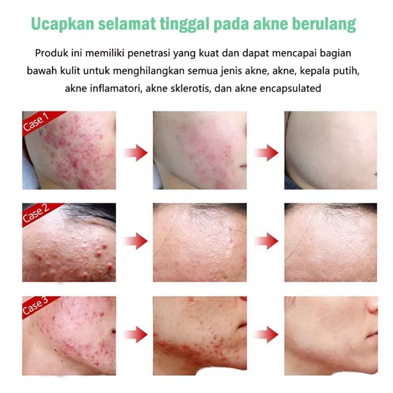 ZHENXIU krim gel anti  jerawat/ salep jerawat 20 gr