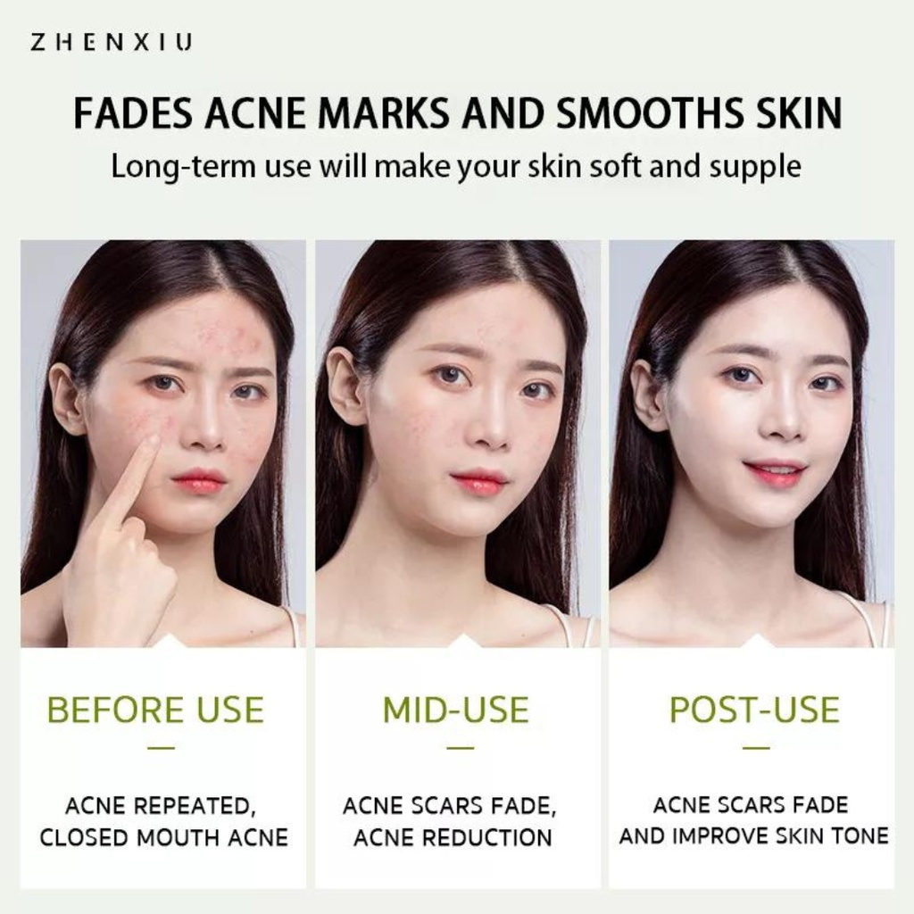 ZHENXIU Krim Anti jerawat dan Memudarkan bekas jerawat Cepat Salep Jerawat 20g Original Anti acne Herbal Essence Menghilangkan Jerawat Memperbaiki Kulit Pria dan Wanita