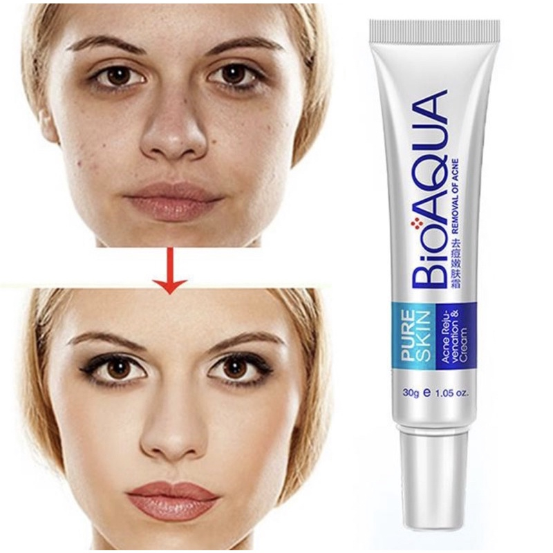 [ ORIGINAL ] OBAT JERAWAT DAN BEKAS JERAWAT AMPUH PURE SKIN REMOVE OF ACNE