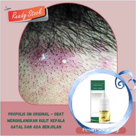 PROPOLIS SM Original - Obat Menghilangkan kulit kepala gatal dan ada benjolan, benjolan seperti jera