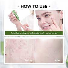 YOU AcnePlus Spot Care Acne Treatment | 4D Centella Asiatica Niacinamide Herbal Obat Jerawat Totol Jerawat