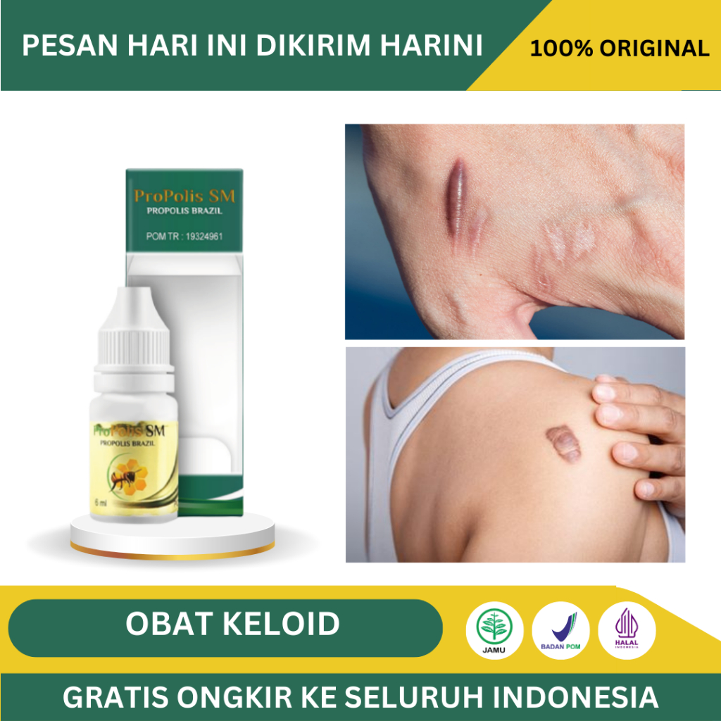 Obat Keloid - Obat Penghilang Keloid Menahun -Obat Keloid Di Dada - Obat Penghilang Keloid Berkerut 