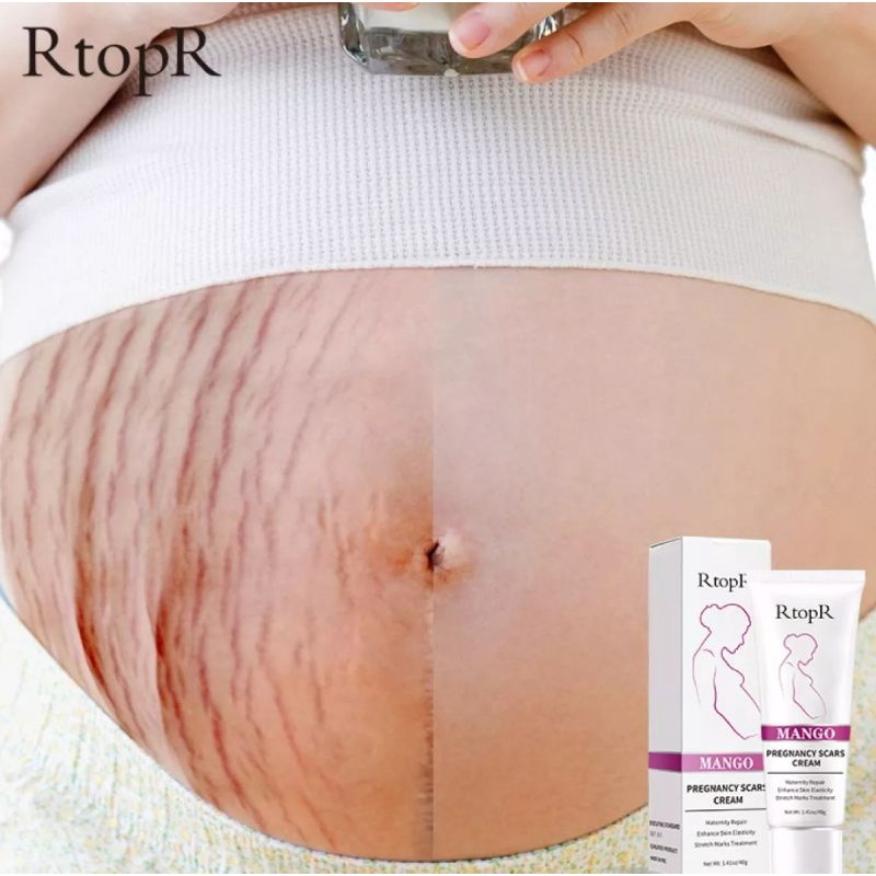 RtopR Mango Remove Pregnancy Scars Acne Cream Stretch Marks Treatment Maternity Repair Anti-Aging Anti-Winkles Firming Body Creams