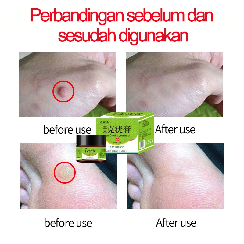 Krim kutil obat penghilang kutil penghilang kutil 20g skin tag remover Menghilangkan kutil, tahi lalat, berbagai skin tag di berbagai bagian tubuh