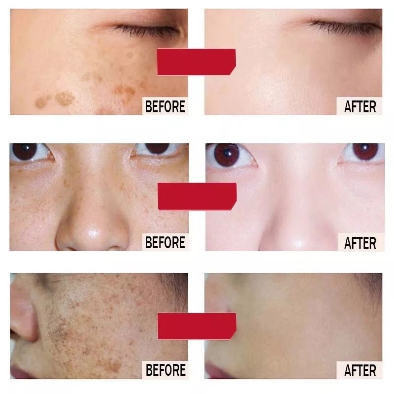 ( BISA COD ) Cindynal Salep Cream Ampuh Pemutih Wajah Menghilangkan Flek Bintik Noda Hitam Jerawat dan Bekas Jerawat Ampuh Pria Wanita Krim Whitening Freckle Cream Remove Dark Spots