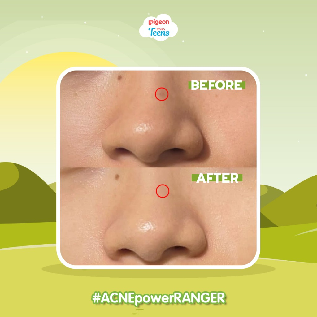 Pigeon Teens Acne Ranger Series | Perawatan Kulit Remaja Berjerawat