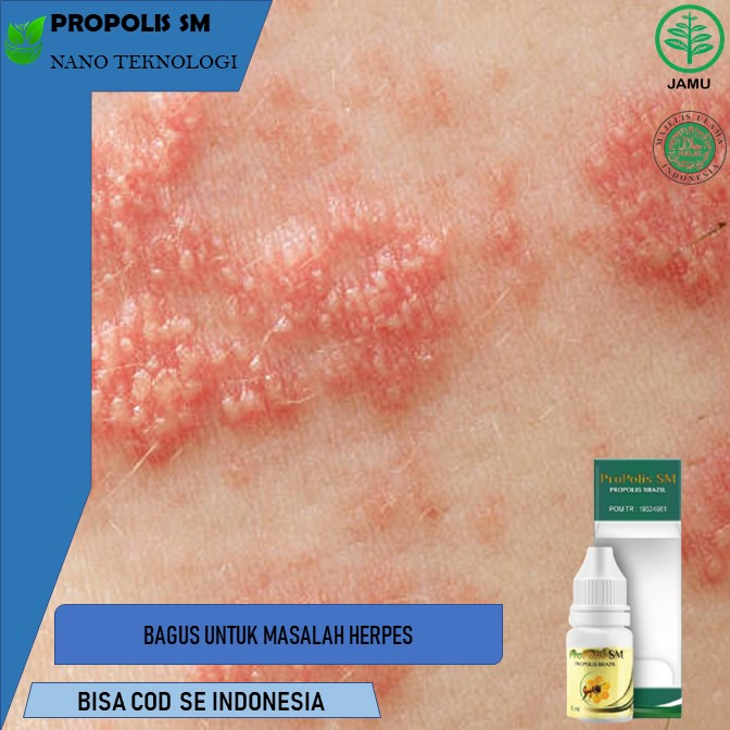 obat herpes obat herpes kelamin  obat herpes genital Obat Herpes, Obat Herpes Kulit, Obat Herpes Kel