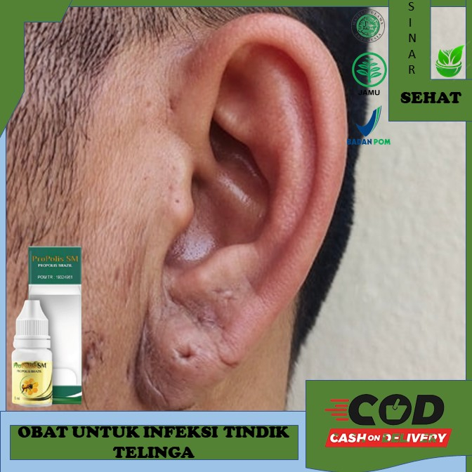 Obat Infeksi Tindik Telinga Bengkak Dan Bernanah Propolis SM - Obat Keloid, Obat keloid Luka tindik,