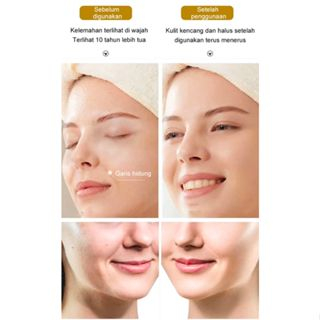 Tersedia Korea Microcrystalline Nasolabial Folds Anti-Wrinkle Patch Mata Anti Kerut Patch Lipatan nasolabial mikrokristalin Korea patch anti-kerut, penutup mata anti-kerut, patch dahi anti-kerut