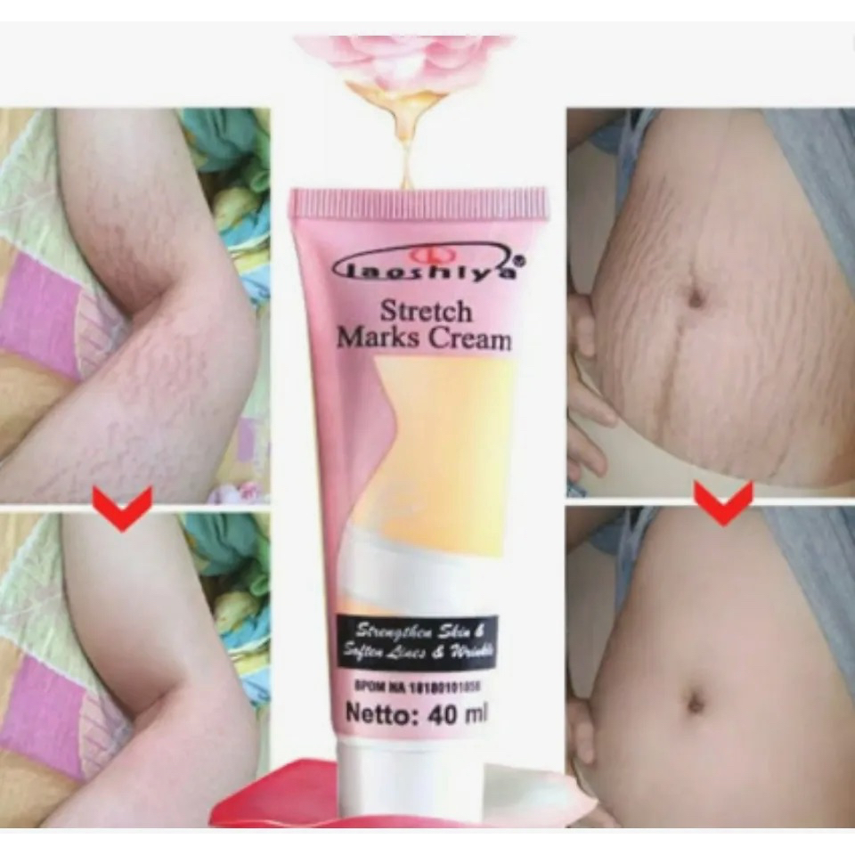 `ღ´ PHINKL `ღ´ Cream laoshiya anti strech mark bekas luka garis putih penghilang keloid