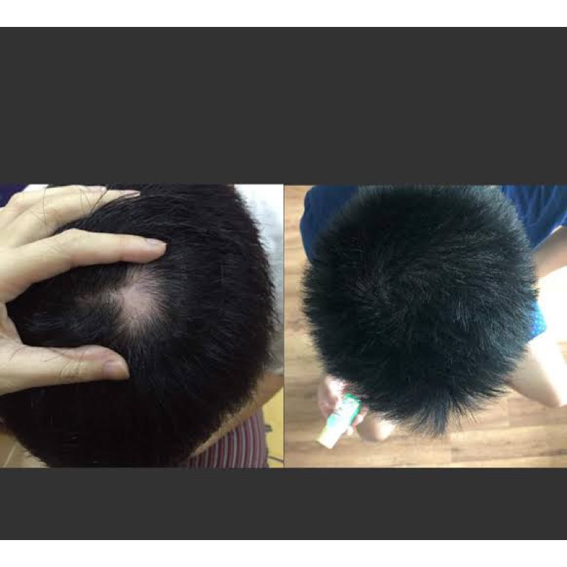 SERUM PENUMBUH RAMBUT DAN ANTI RONTOK JEPANG MENUMBUHKAN JUGA MELEBATKAN EFEKTIF DAN PASTI BERHASIL SERUM ALOPECIA SERUM SEBORRHEA