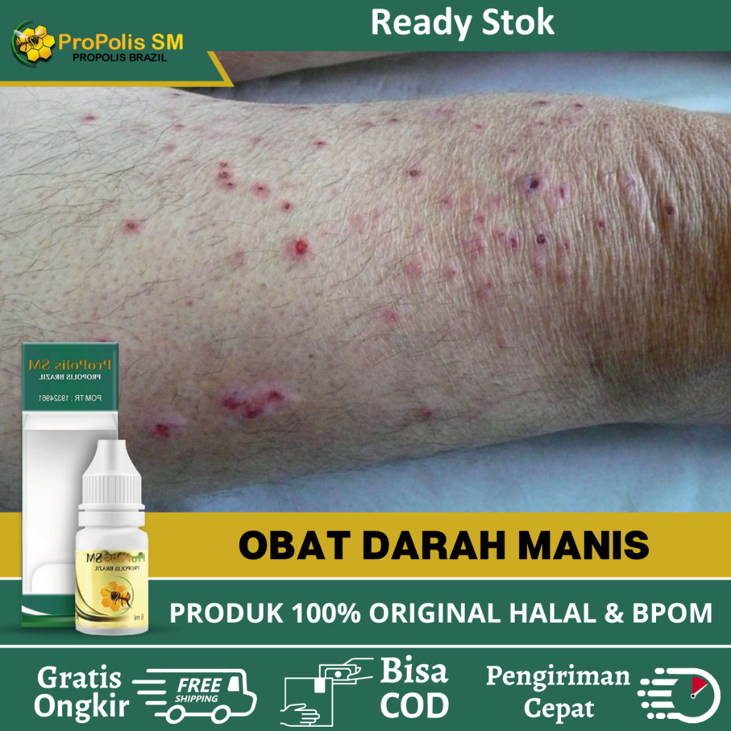 Obat Darah Manis, Obat Prurigo Darah Manis Pembersih Darah, Obat Gatal Darah Manis, Obat Gatal Pruri