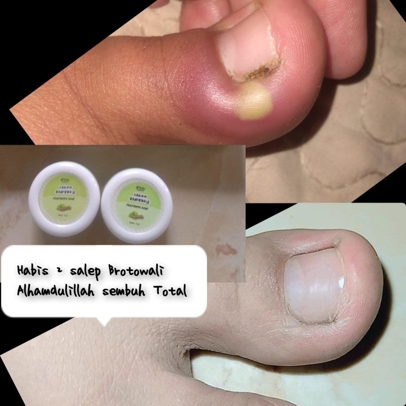 cream brotowali bnyu salep gatal gatal