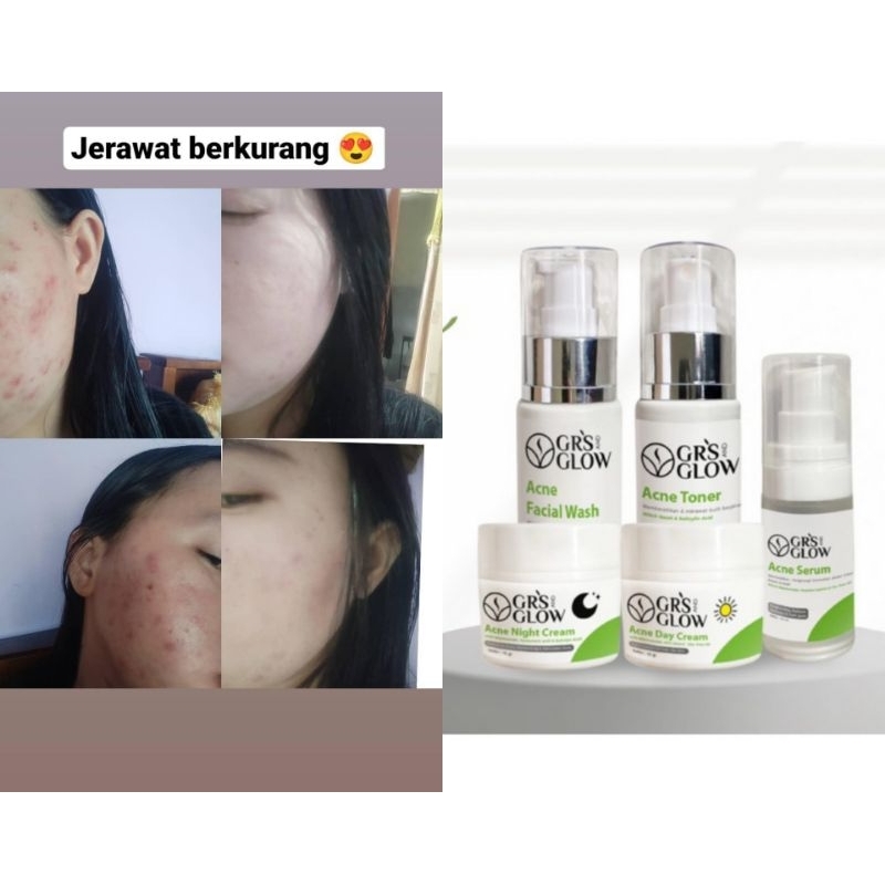Grs and glow paket acne jerawat