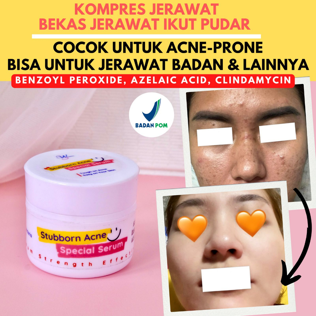 KOMPRES JERAWAT &amp; BRUNTUSAN - KRIM BEKAS JERAWAT - Cream Bopeng - Salep Jerawat - Obat Jerawat by WAZATARU