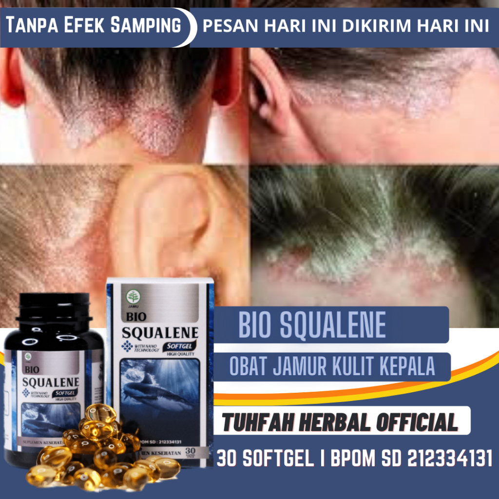 Obat Tinea Kapitis Jamur Di Kepala, Obat Jamur Kulit Kepala, Luka Di Kepala, Jamur Kulit Kepala, Tin