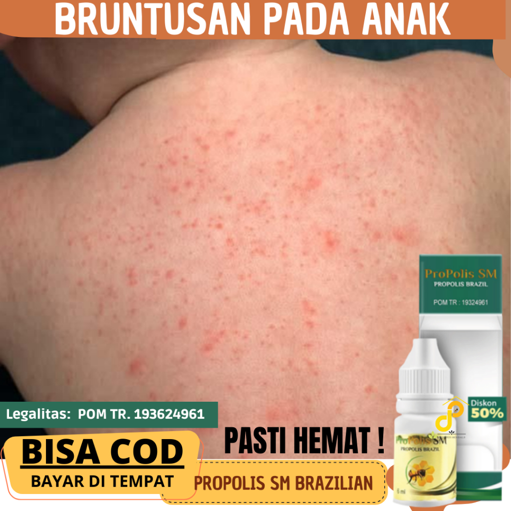 Obat untuk mengatasi beruntusan pada selangkangan bayi, bintik berair,  gatal pada sela jari tangan,