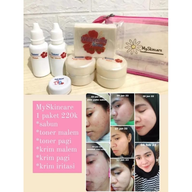 Myskincare || solusi jerawat || krim wajah || obat jerawat