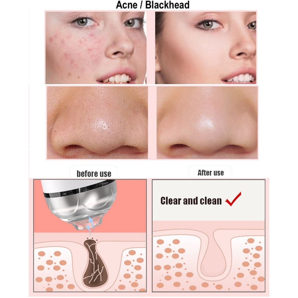 Trend-Blackhead Cleaner Alat Penghisap Komedo Acne Suction Remover Skin Care