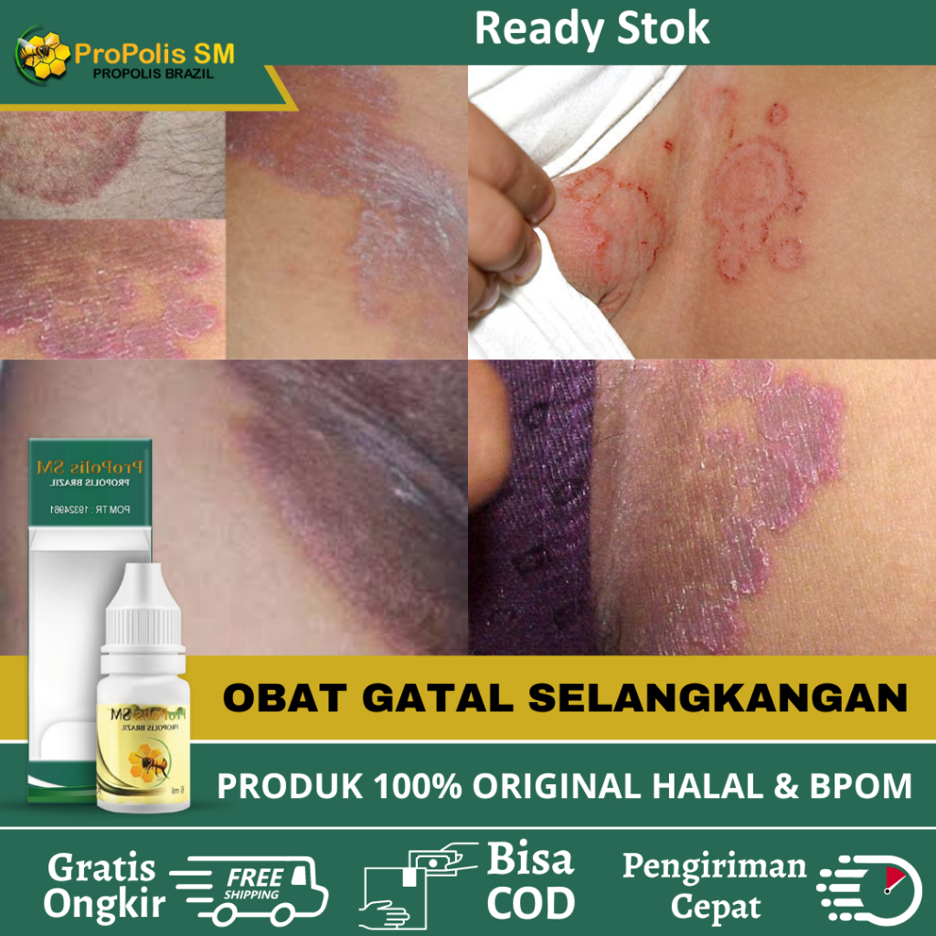 Obat Gatal Selangkangan, Obat Gatal Di Selangkangan, Obat Jamur Selangkangan, Obat Selangkangan Hita