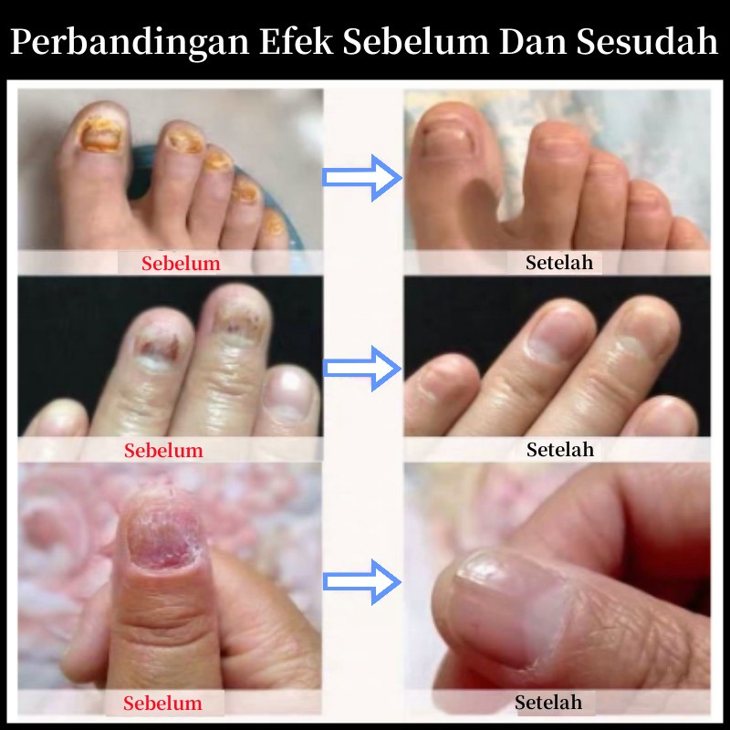 Obat Jamur Kuku Obat kuku jamur dan rusak Perawatan Kuku Berjamur Antibakteri Perawatan Kuku Onikomikosis Paronychia Anti Infeksi Kuku Toe Nail Pengobatan Jamur Minyak Nail Repair Essence Serum