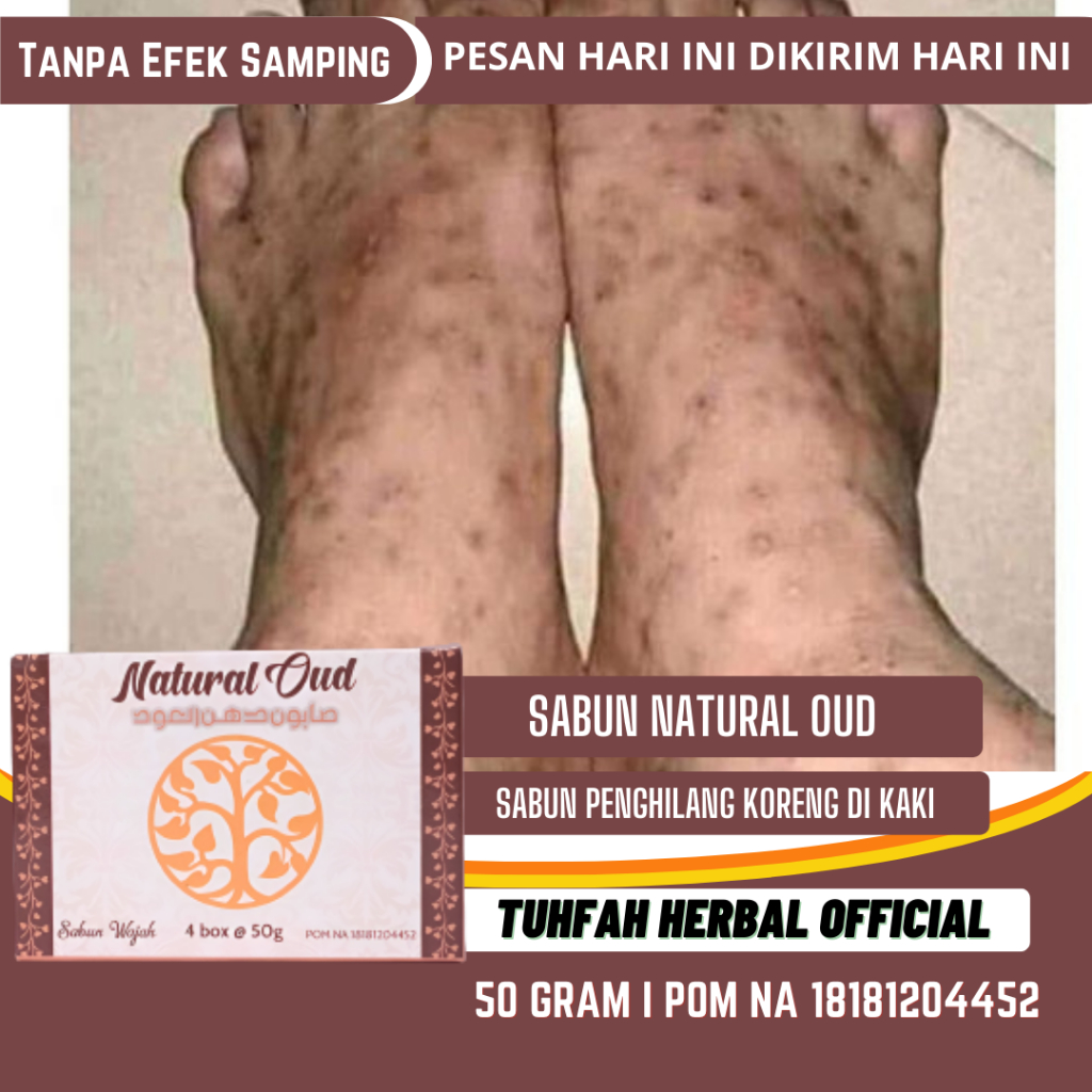 Obat Koreng, Penghilang Bekas Koreng, Penghilang Bekas Budug Di kaki, Menghilangkan Koreng Gatal Aki