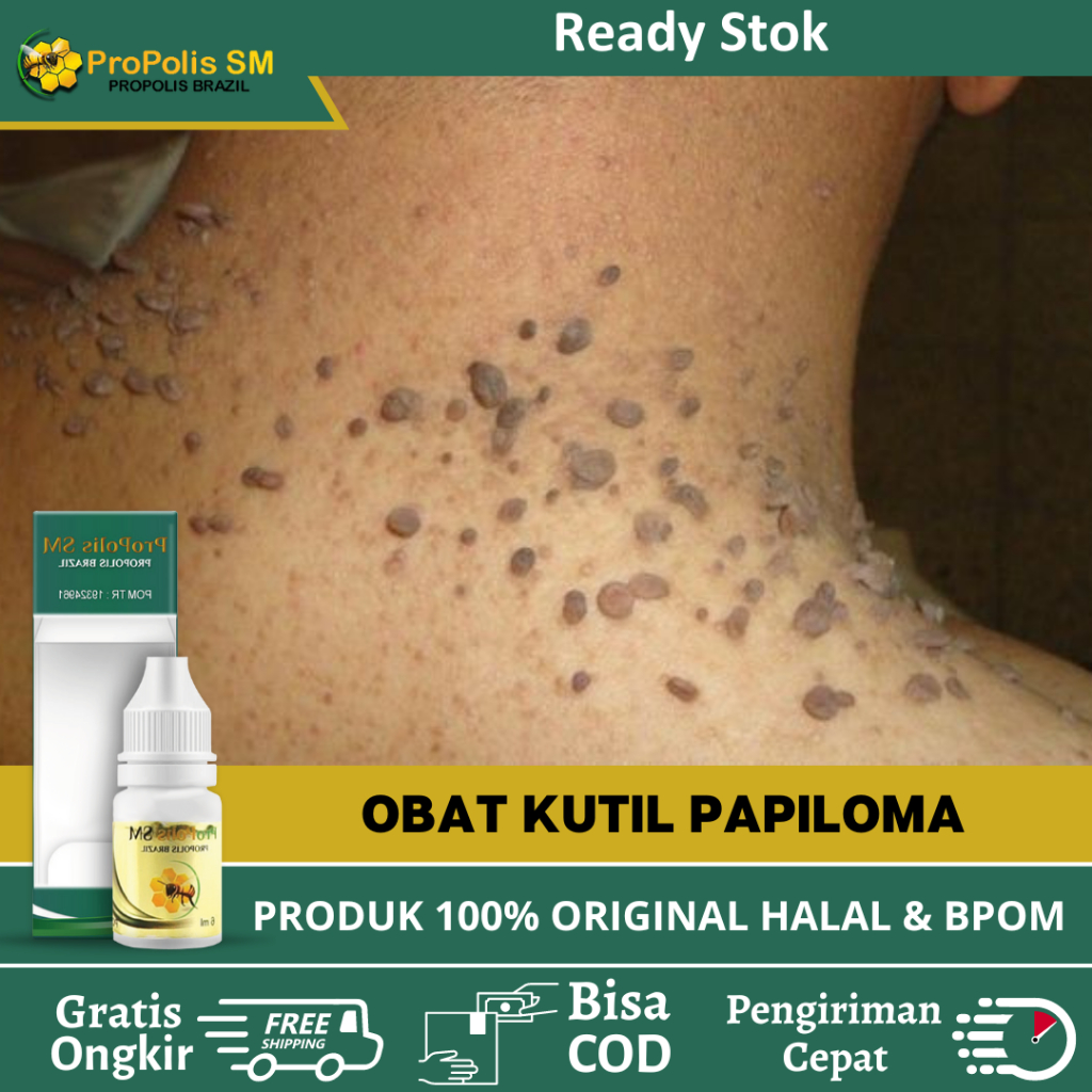 Obat Kutil Papiloma di Leher - Obat Penghilang Kutil - Obat Perontok Kutil Papiloma - Obat Skin Tag 