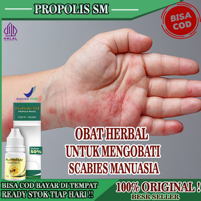 Obat Scabies Pada Manusia, Obat Pantat Gatal Karena Infeksi Jamur Kulit, Obat Kudis (Scabies) yang A