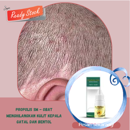 PROPOLIS SM - Obat Menghilangkan kulit kepala gatal dan bentol, Atasi benjolan di kulit kepala, Hila