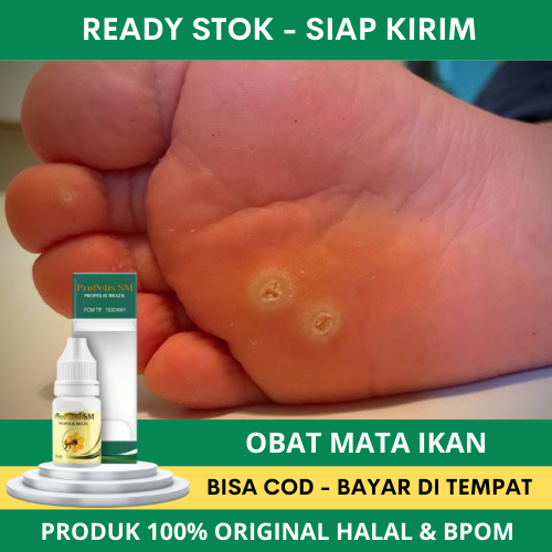 Obat Mata Ikan, Obat Perontok Mata Ikan di Telapak Kaki, Obat Mata Ikan di Telapak Kaki / Tangan, Ob