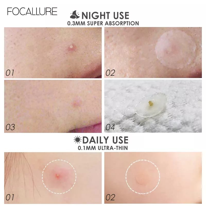 FOCALLURE ACNE PIMPLE PATCH STIKER PENGEMPES JERAWAT AMPUH MENGILANGKAN JERAWAT DALAM 24 JAM