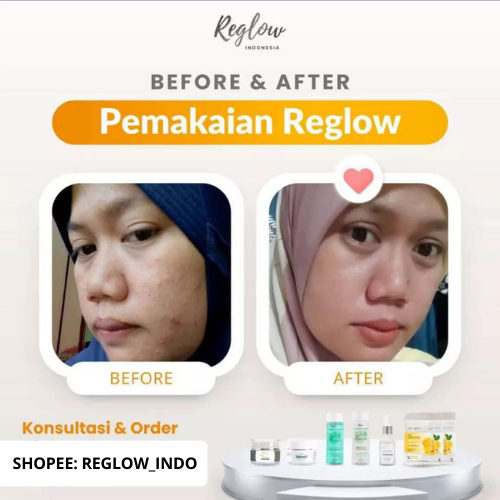 Reglow Skincare Original Official dr Shindy Putri 1 Paket Lengkap Perawatan Flek Hitam Membandel Di Wajah Red Glow Ori