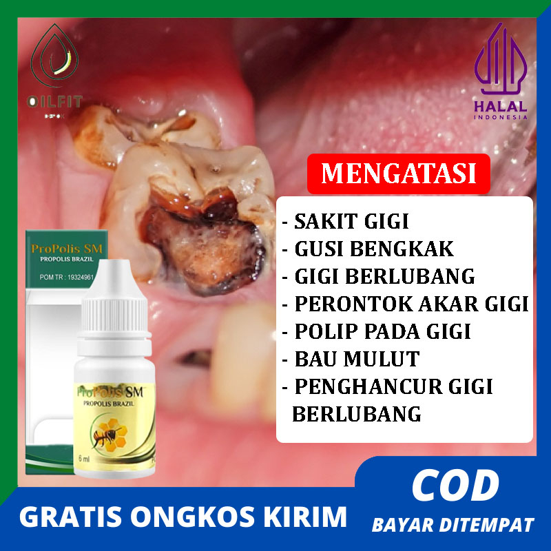 Obat Perontok Akar Gigi Berlubang Perontok Gigi Sampai Ke Akar Gigi Berlubang Agar Cepat Sembuh Peng