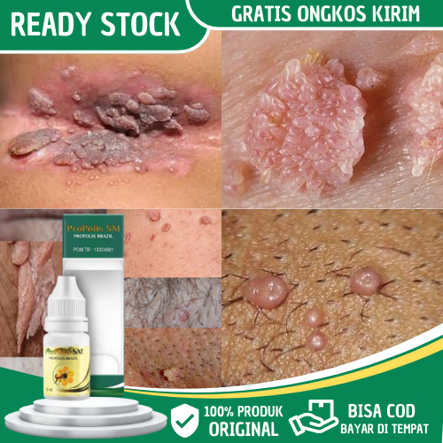 Propolis SM - Obat Kutil Kelamin, Obat Kutil Kelamin HPV, Obat Kutil Kelamin Laki Laki, Obat Kutil W