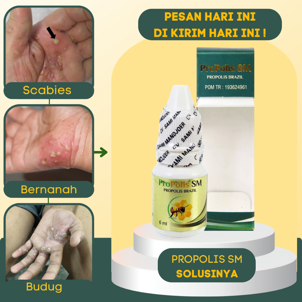 Obat Salep Gatal Borok Budug Bernanah, Obat Budug di Kaki Dan Tangan, Obat Scabies Manusia Untuk Ana