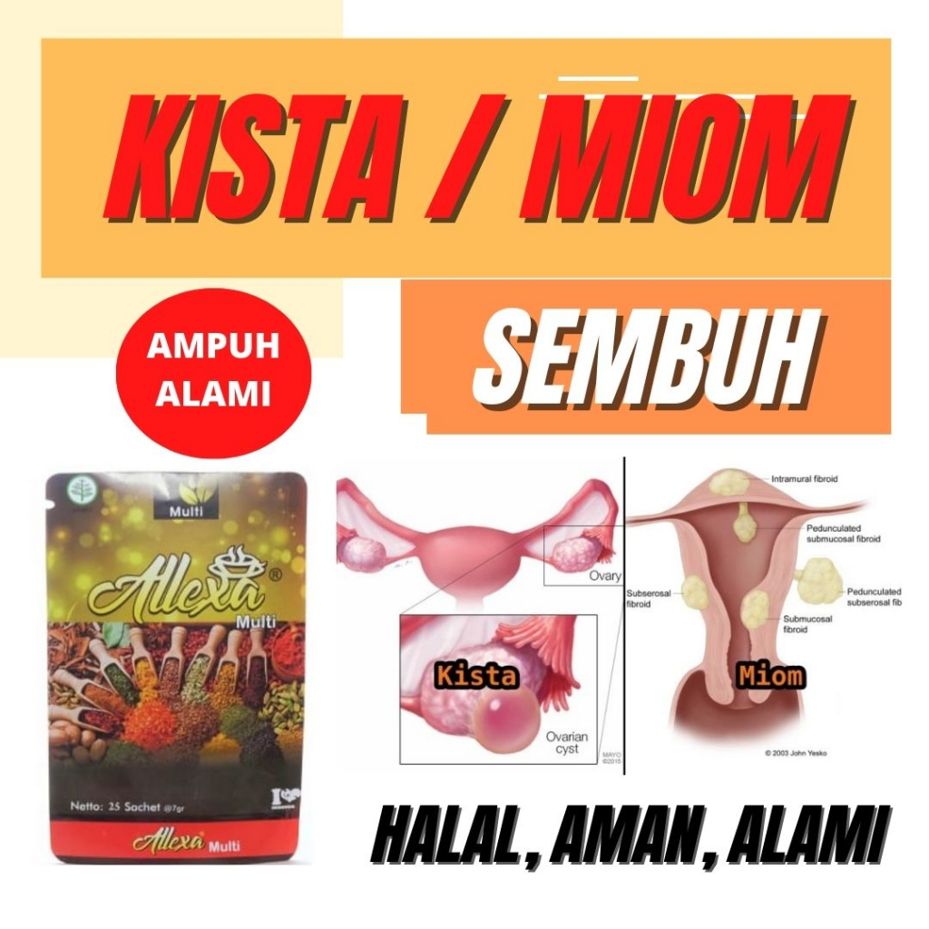 Allexa Multy - Obat Kista ALAMI Isi 25 Pcs Obat Kista Tradisional Obat Kista Bartholin Obat Kista Co