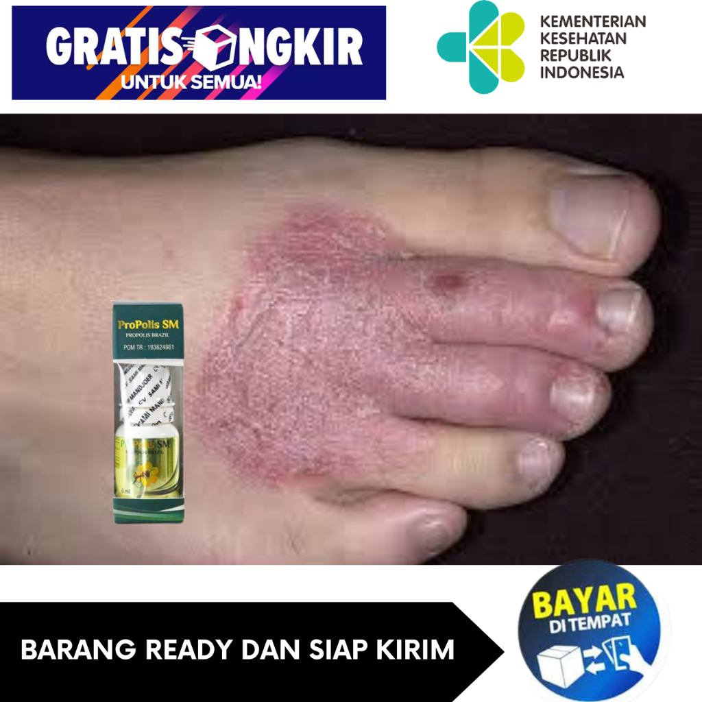 Obat Tetes Luka Diabetes Obat Luka Diabetes Kering Obat Luka Diabetes Basah Obat Luka Diabetes Berna