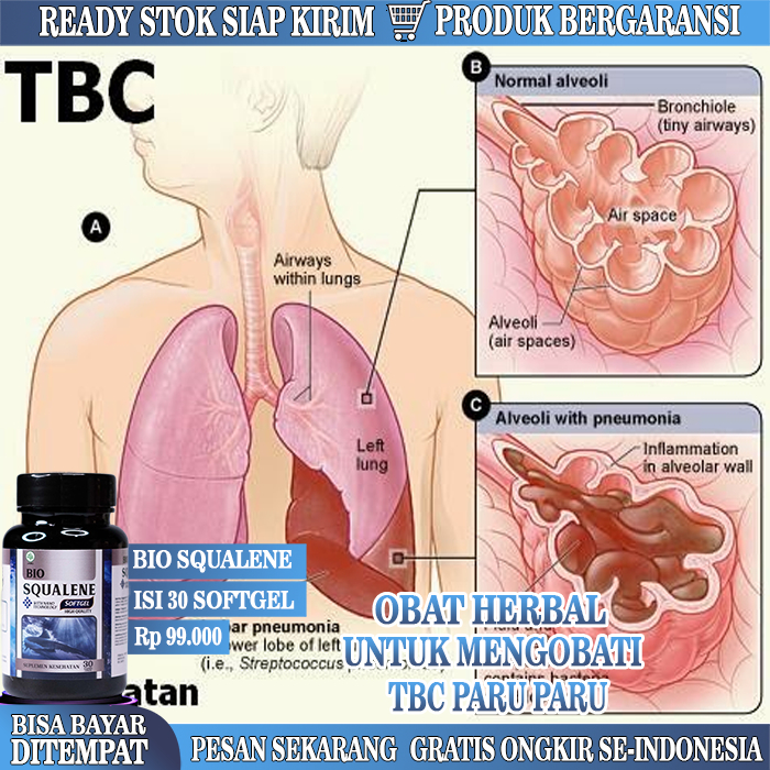 Obat TBC Paru, Obat Paru Paru TBC Asma, Bio Squalene, Flek Paru Paru, Paru Paru Basah, Obat Tuberkul